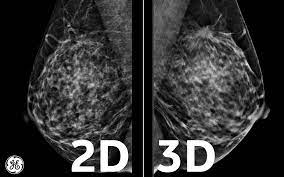 Bright spots on a mammogram that look like potential tumors could turn out to be overlapping tissues or a blood vessel folding over on itself, friedewald said. Ge Healthcare United States