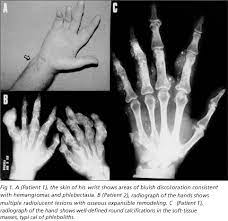 Maffucci S Syndrome Complicated By Intracranial Chondrosarcoma Two New Illustrative Cases