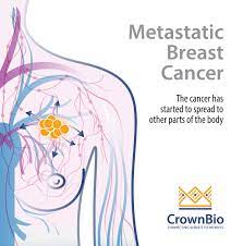During a physical exam, your health care provider will feel under your arm to check if the lymph nodes are enlarged. Why Pdx Are Needed For Metastatic Breast Cancer Research