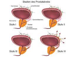 Der prostatakrebs ist eine bösartige tumorerkrankung und geht vom drüsengewebe der vorsteherdrüse aus. Prostatakrebs Stz Freiburg Zentrum Fur Strahlentherapie
