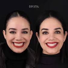On this occasion we decided to improve the smile of one of our colleagues  and team leaders at Dental 32. 😎🌟 This case was handled by Dr. Armando  Fuentes, and was performed
