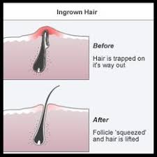 An infected ingrown hair can cause a lot of problems which can turn from a minor infection to major. Ingrown Hair Cyst Causes Pictures Removal Treatment And Remedies