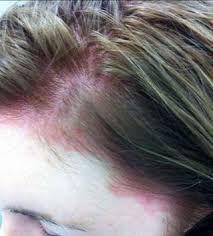 Allergy to hair dye can produce symptom or reaction known as urticaria which is commonly known as hives. Woman Has Horrible Allergic Reaction To Salon Hair Dye Job Ppd Allergy Photos