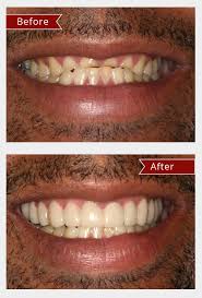 Do snap on veneers look real? Snap On Smile