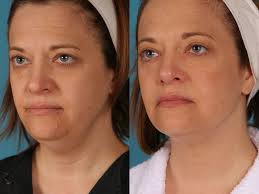 In A Series Of Comfortable No Downtime Treatments Exilis Elite Skin Tightening Disrupts Aging Collagen And Stimulates A Natural Healing Process That Results I