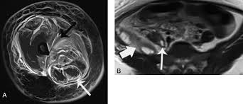 Swarming of maggots crawling over the carcass cavities. Missed Acute Appendicitis Presenting As Necrotising Fasciitis Of The Thigh Bmj Case Reports