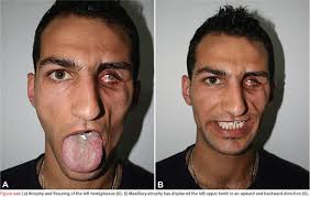 Parry-Romberg syndrome: a mini review.