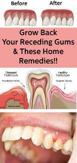 To see good results, you should take a quarter cup of sesame oil and then carefully stir the mouth with it. How To Stop Receding Gums At Home Arxiusarquitectura