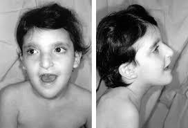 Neurocristopathies Presenting With Neurologic Abnormalities Associated With  Hirschsprung's Disease