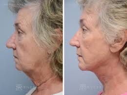Landing Facelift Ads