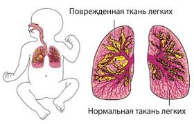 Pnevmoniya U Detej Prichiny Razvitiya Patologii Harakternye Priznaki I Simptomy Lechenie Medikamentami I Narodnymi Sredstvami V Domashnih Usloviyah Povody Dlya Gospitalizacii