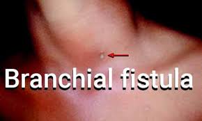 Antibiotics may be needed to treat or prevent a bacterial infection. Branchial Fistula Standard Treatment Guidelines By Government Of India