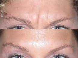 In 2017, botulinum toxin was the top nonsurgical cosmetic procedure in the u.s., with 1,548,236 injections (of botox, dysport and xeomin) performed by physicians and their physician assistants and nurse. Botox Santa Rosa Botox Injections In Santa Rosa Artemedica