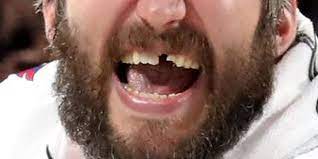 Check spelling or type a new query. Alex Ovechkin Lost Another Tooth During The Capitals Stanley Cup Championship Run