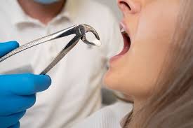 Image result for Tooth Extraction
