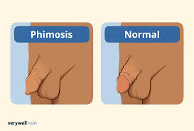 Image result for Phimosis
