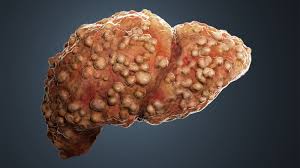 Cirrhosis of the liver pictures. How Does Underlying Cirrhosis Affect Covid 19 Medpage Today