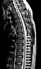Yes, transverse myelitis causes complications if it is not treated. Infectious Acute Transverse Myelitis Secondary To Covid 19 Rebel Em Emergency Medicine Blog