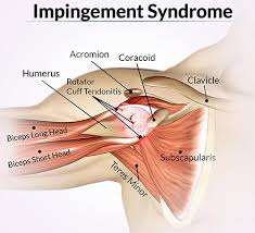 There is also an important nerve that travels around the back of the shoulder joint to. Nyc Shoulder Impingement Treatment Doctor Shoulder Specialist Sports Injury Clinic
