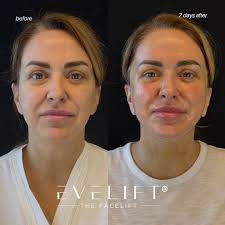 Good job, Dr. C!” 🎉 For her 50th birthday, Cheryl traveled from North  Carolina to gift herself the ultimate glow-up: ✨ EVELift® ✨ Smart Peel CO2  Laser Resurfacing And wow — we