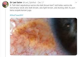 Cara membuang tahi lalat di muka di klinik. Tahi Lalat