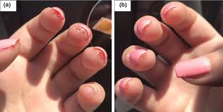 We did not find results for: Acrylates New Sources And New Allergens Voller 2020 Clinical And Experimental Dermatology Wiley Online Library