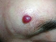 A hemangioma can occur anywhere on the body, but most commonly appears on the face, scalp, chest or back. Cherry Hemangiomas Doctor V