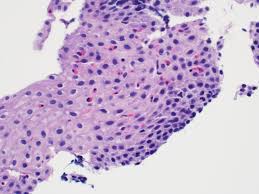 Candida esophagitis (see the image below) is the most common type of infectious esophagitis. Pathology Outlines Eosinophilic Esophagitis