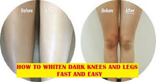 Today we are going to talk about how to lighten dark knees and elbows fast and naturally! Ladies Gentlemen Video Whiten Your Dark Knees And Legs Fast And Easy Without Spending Money Must Watch Uju Ayalogu S Blog For News Reviews Articles And More
