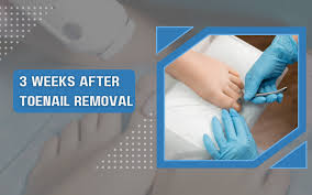 Image result for Toenail Removal