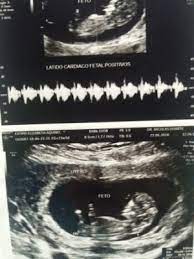 Me Ayudan A Identificar El Sexo De Mi Bebe Segun El Tuberculo Club De Bebes Noviembre 2018 Babycenter