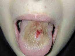 Thoughts On Tongue Piercings Off Topic Giant Bomb