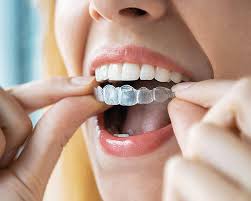 Invisalign in Cary, NC - Cary Implant and General Dentistry