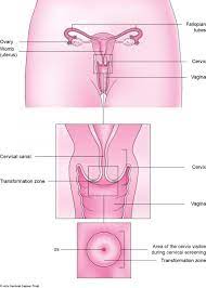 Cervical Ectropion Cervical Erosion Information