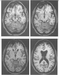 Image result for Frontal Lobe