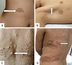 Cutaneous lesions (arrows): Multiple cafe au lait lesions (CAL) (A);... |  Download Scientific Diagram