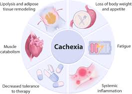 Image result for Cachexia in Cancer