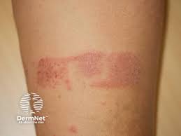 Image result for koebner phenomenon psoriasis