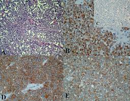 Merkelcell 4.0.0.1 protocol posting date: Merkel Cell Carcinoma World Journal Of Surgical Oncology Full Text