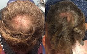 A stem cell hair transplant is similar to a traditional hair transplant. Stem Cell For Hair Loss Dr Ben Behnam Md Faad Best Dermatologist Los Angeles