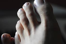 Image result for Pitting nails feet