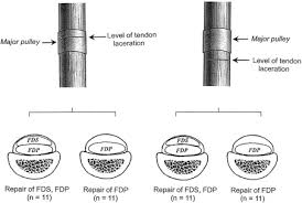 After surgery, your forearm and hand will be in a large bandage and plaster splint. Effects Of Superficialis Tendon Repairs On Lacerated Profundus Tendons Within Or Proximal To The A2 Pulley An In Vivo Study In Chickens Sciencedirect