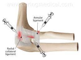 It occurs when repeated movements cause swelling and pain in your joint and tendons. Tennis Elbow Pain Treatments Conservative Care Injections Surgery Caring Medical Florida