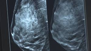Stage of breast cancer and as an aid in decision making. Advocates Using P E I Election To Secure Support For Breast Density Notification Cbc News