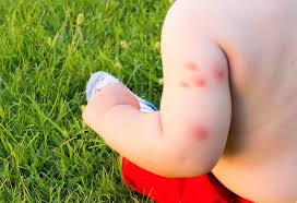 No toxic chemicals, no odor, no stains. How To Deal With Bed Bug Bites On Babies Children