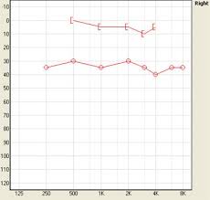 Were going to take some time and go through this step by step. 15 Audiograms Ideas Audiology Audiology Student Hearing Loss