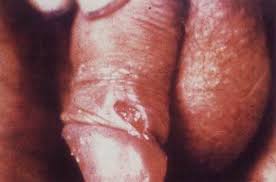 Image result for chancroid