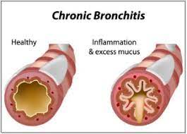 Chronic Bronchitis - Physiopedia