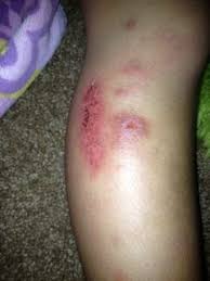 Bites That Look Like Mosquito Bites Pin On Health Concerns