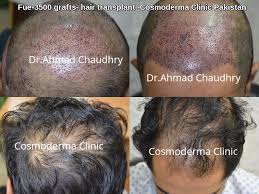 Patient before and after his crown hair restoration with 1500 fue grafts from the scalp.* Fue 3500 Grafts Hair Transplant Pakistan Cosmoderma Clinic Lahore Dr Ahmad Chaudhry